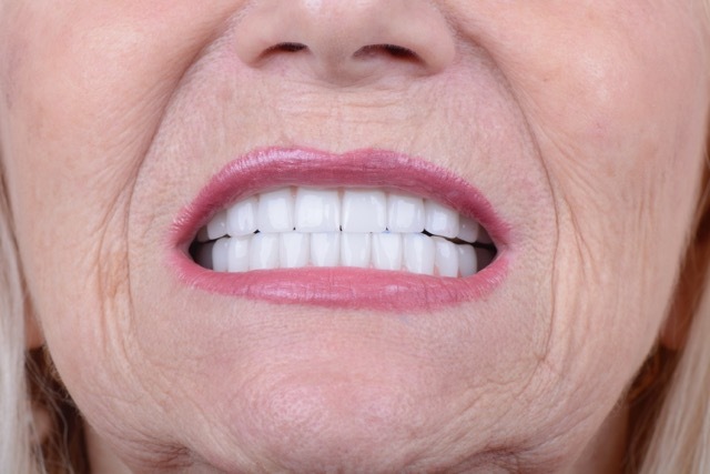 Close-up of patient smile restoration