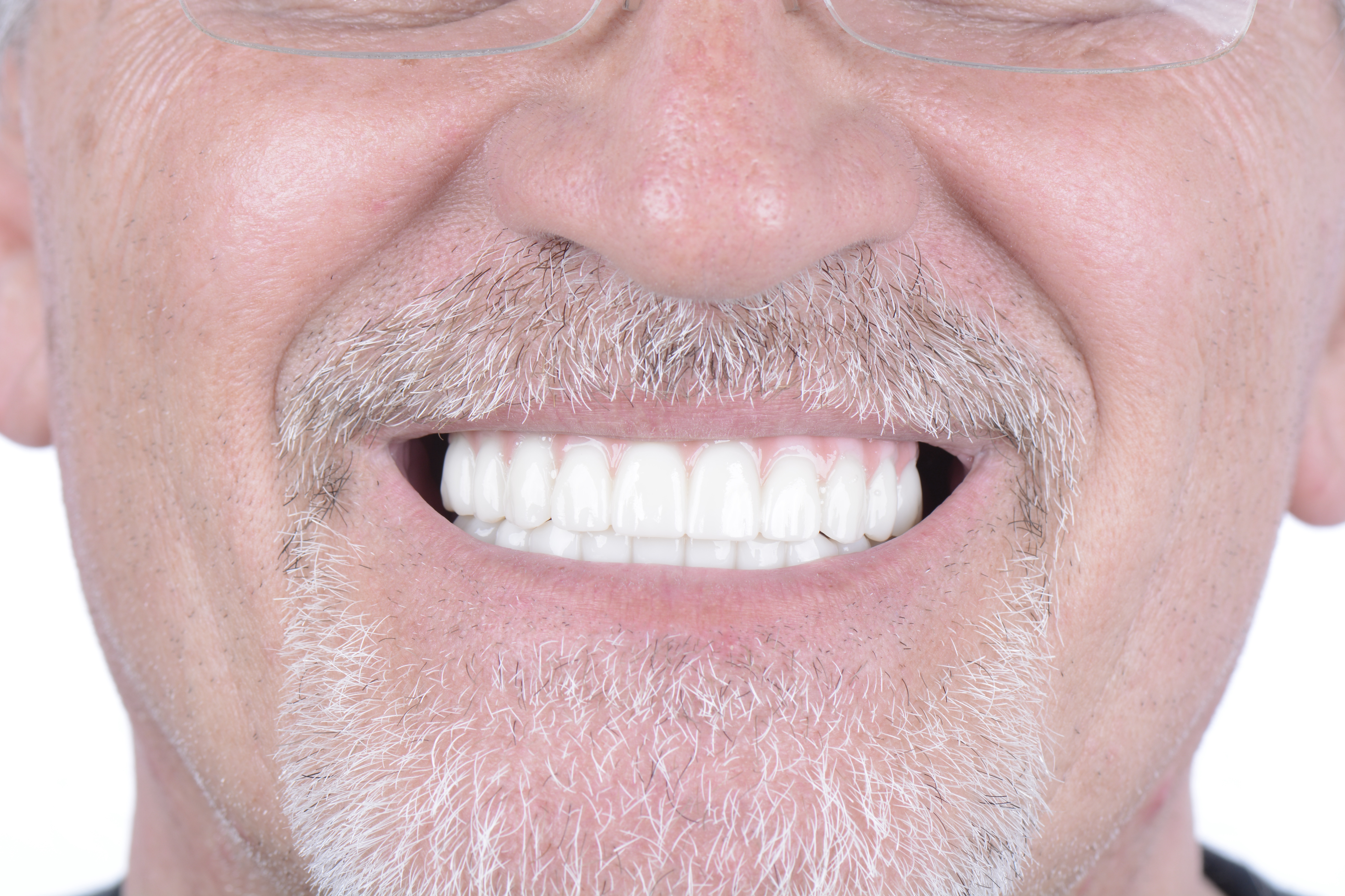Clinical close-up of dental implants
