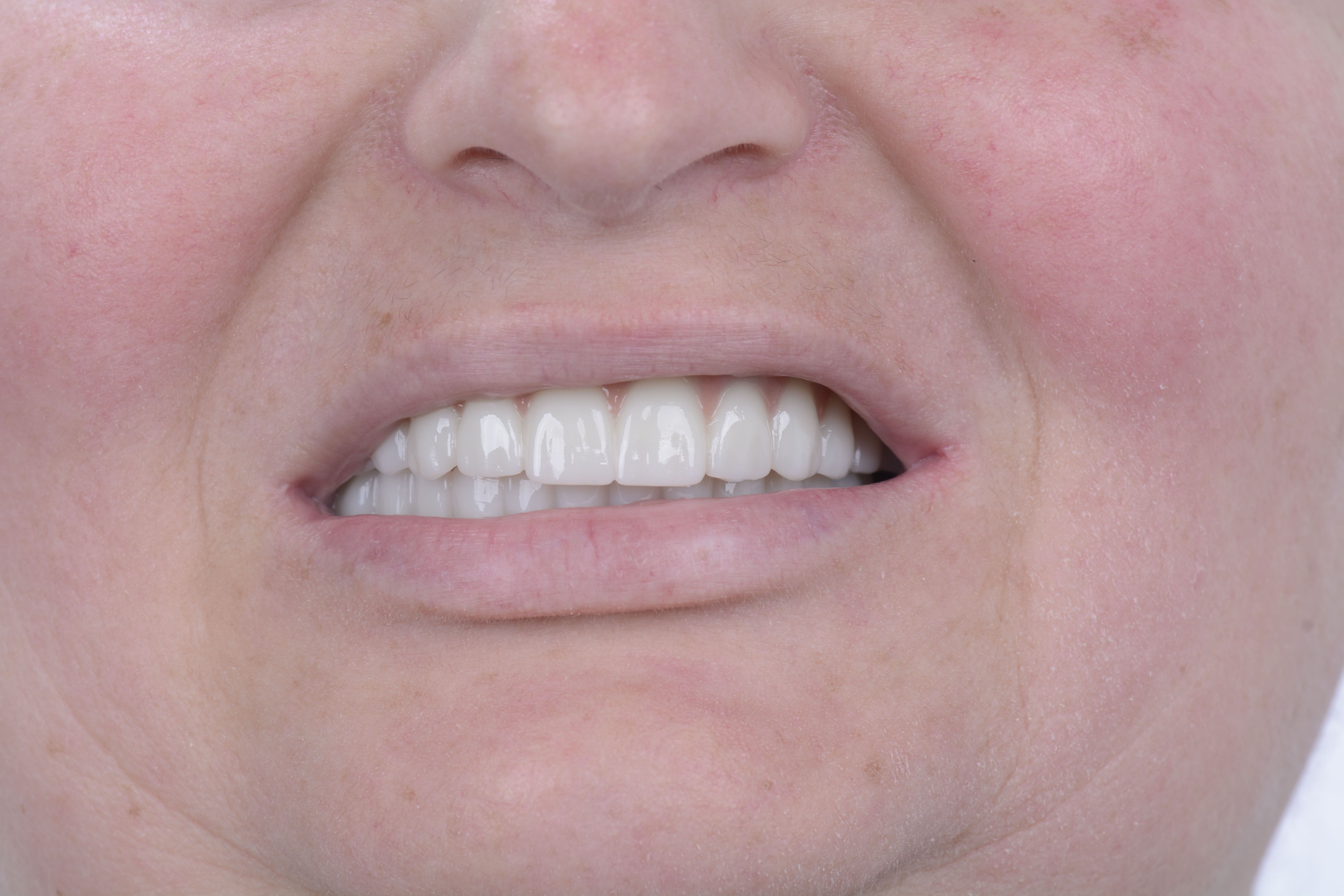 Clinical close-up of dental implants
