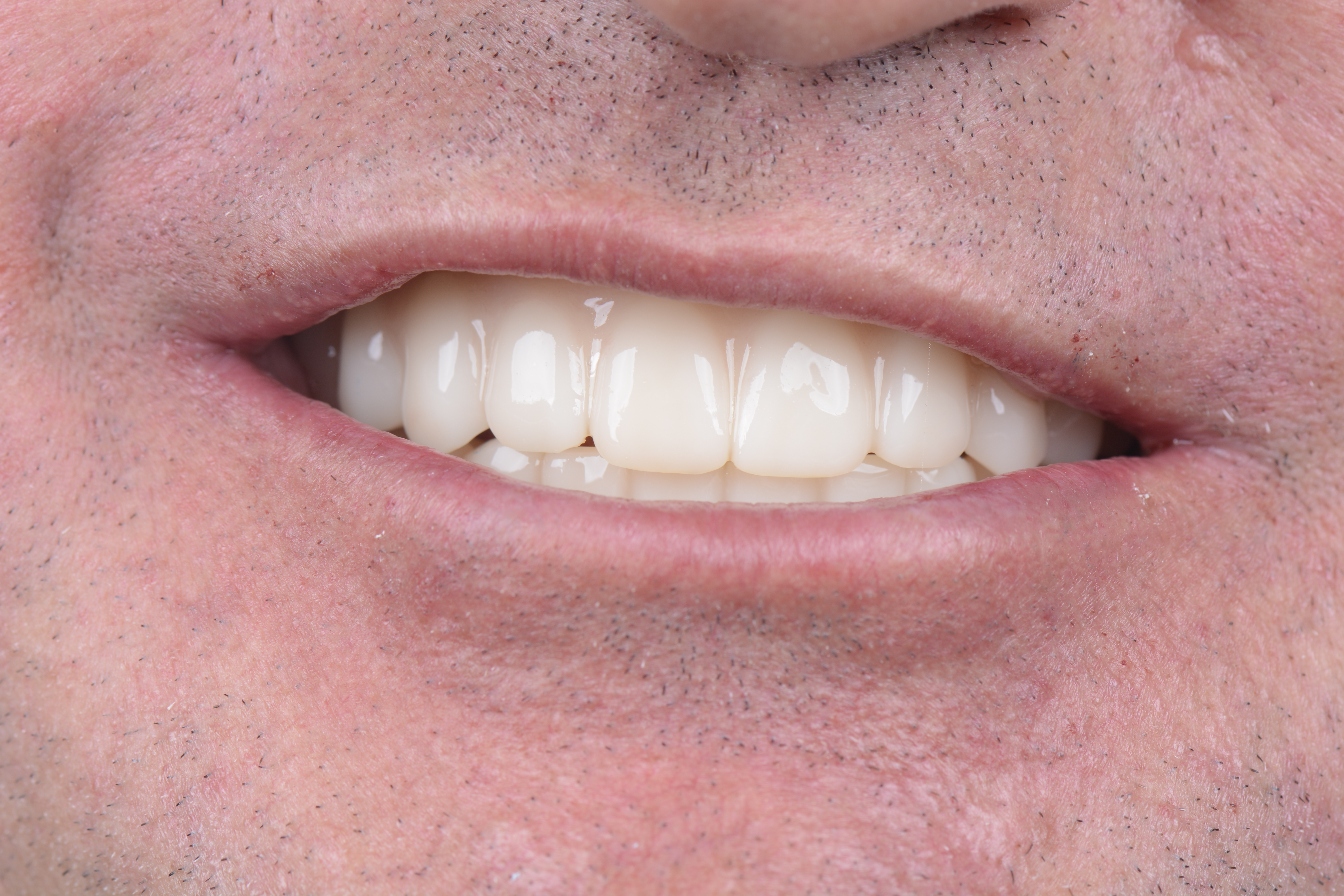 Clinical close-up of dental implants